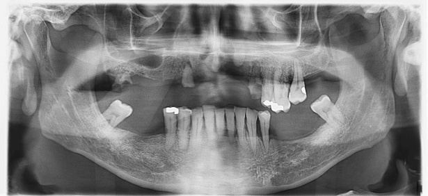 Technique Avancée d'OpenRewrite : Orchestrer des refactorings complexes avec les `ScanningRecipe`